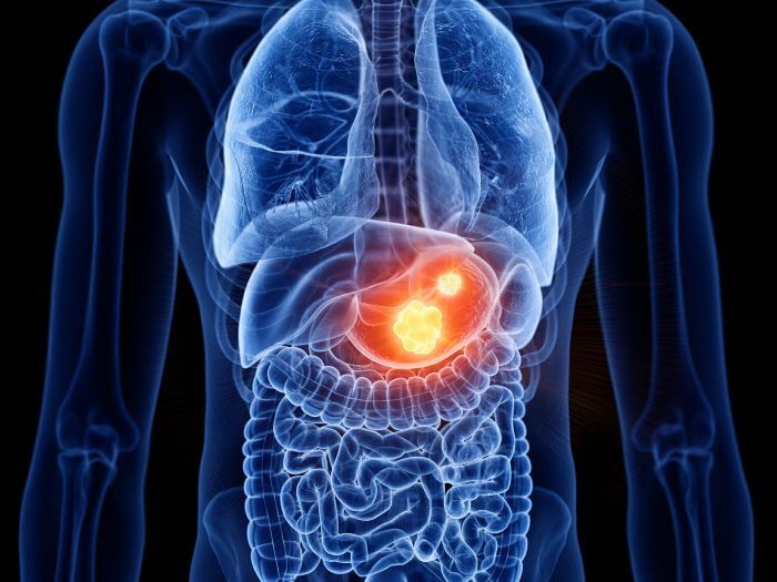 Tumor Estromal Gastrointestinal